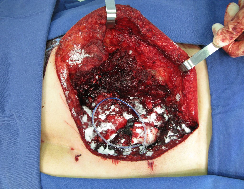 Figura 159: Colocação de hemostático de partes moles.