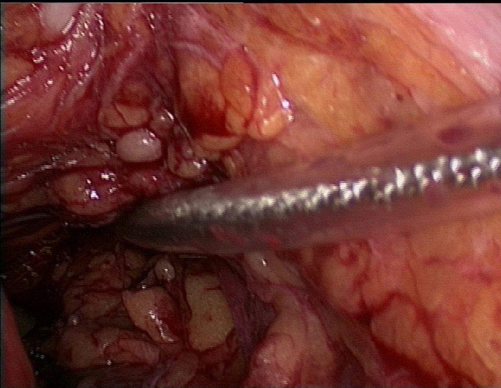 Figura 115: descrição da cirurgia vídeo Laparoscópica.