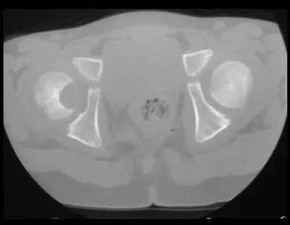 Figura 2– erosão da cartilagem articular.