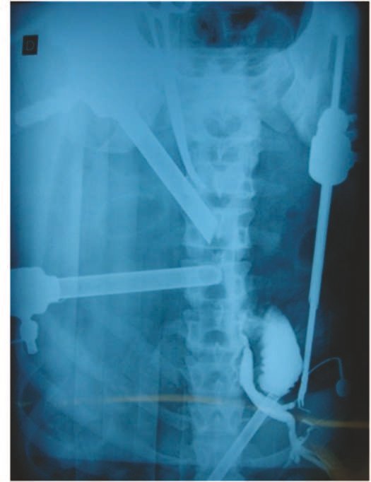 Figure 3 - Intra-operative Cholangiography.