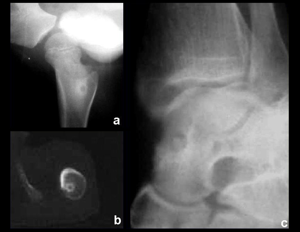 Figura 3: Osteoma osteóide na medular do fêmur (a); tomografia confirmando a localização central (b); osteoma osteóide medular do tálus (c).