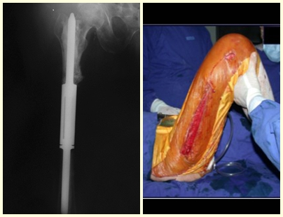 Figura 36: Radiografia de controle. Figura 37: Função restabelecida. Carga autorizada no pós operatório imediato.