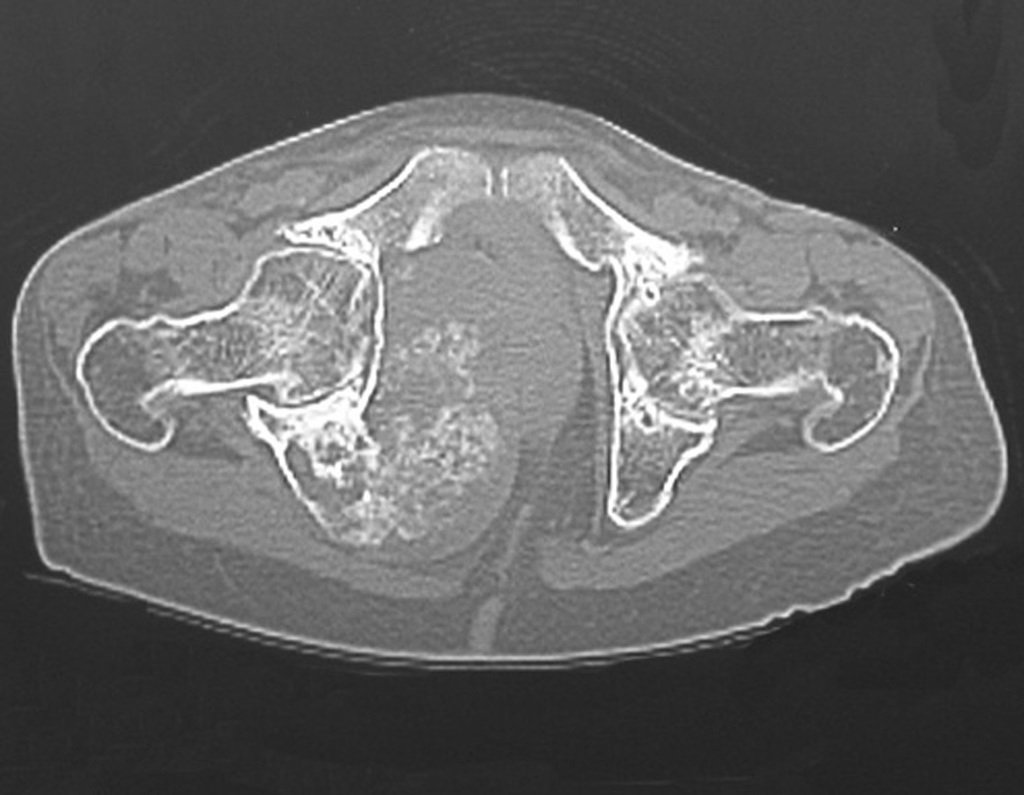 Figura 39: Tomografia da lesão.