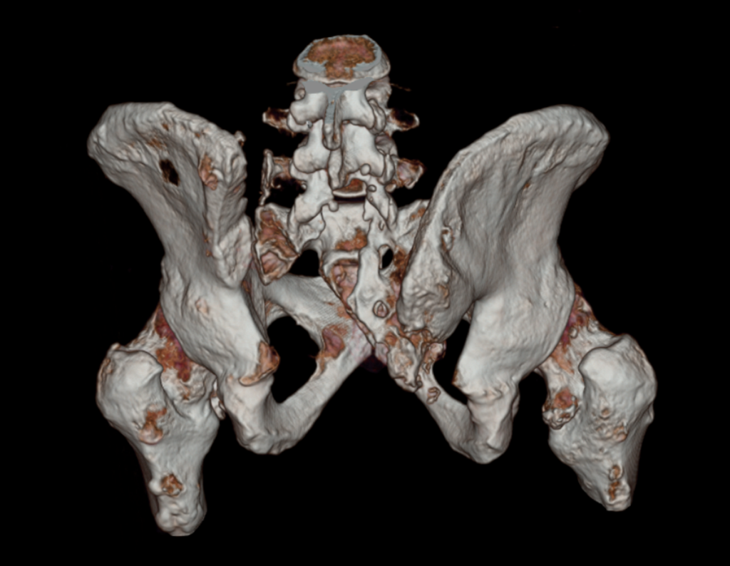 Figura 167: TC em 3D vista posterior, evidenciando a ressecção do hemi-sacro do lado esquerdo.