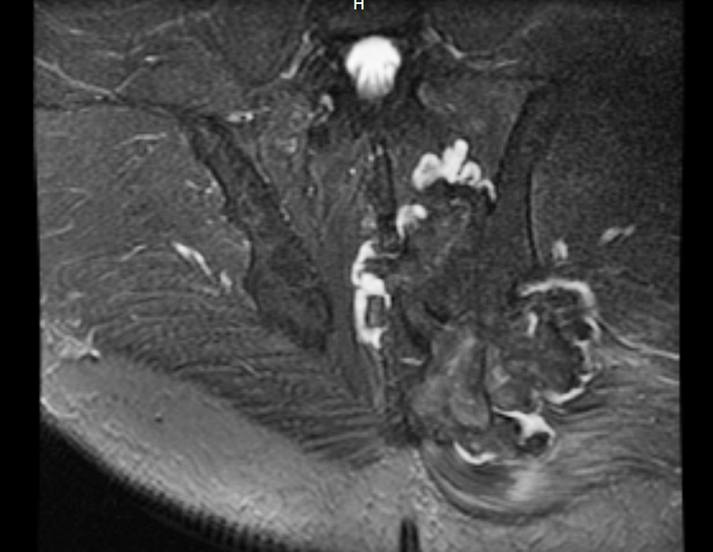 Figura 30: Rm cor T2 , mostrando o grande volume do tumor na região posterior do ilíaco.