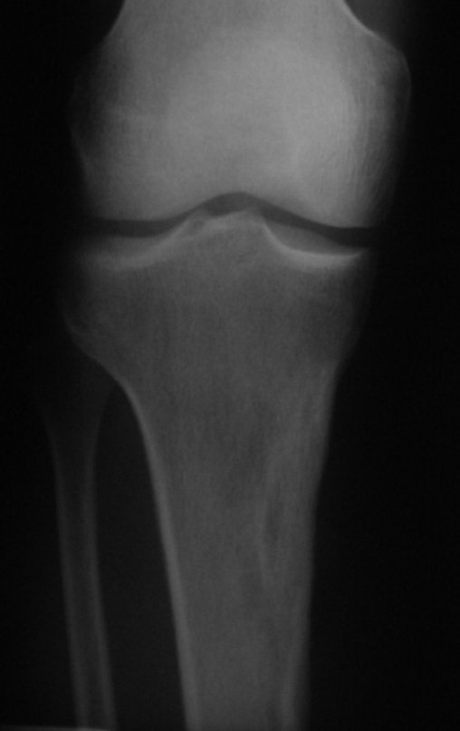 Figura 102: Radiografia mostrando cicatrização do leito ósseo cruento, que se encontra em remodelação.