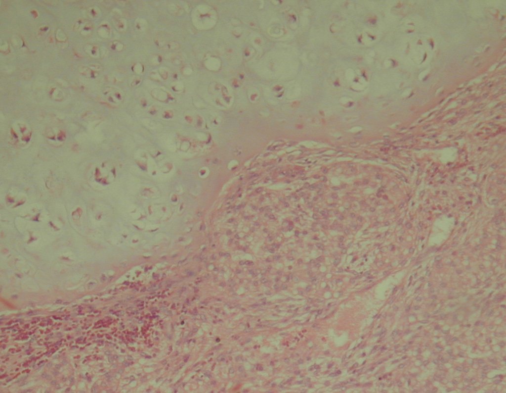 Figura 35: Condrossarcoma desdiferenciado.