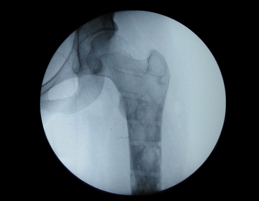 Nesta radiografia do quadril frente podemos visualizar a marca da retirada dos parafusos.