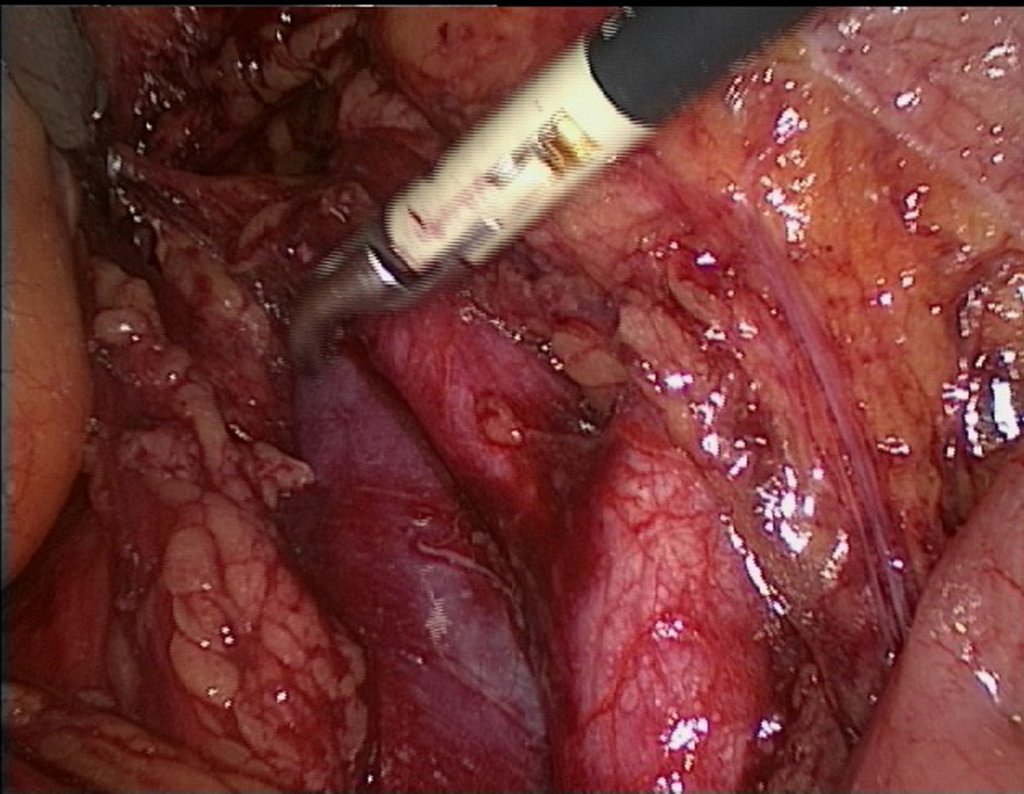 Figura 69: A video cirurgia permite visualizar melhor o espaço retroperitoneal. Está região é de difícil acesso a céu aberto pela via abdominal.