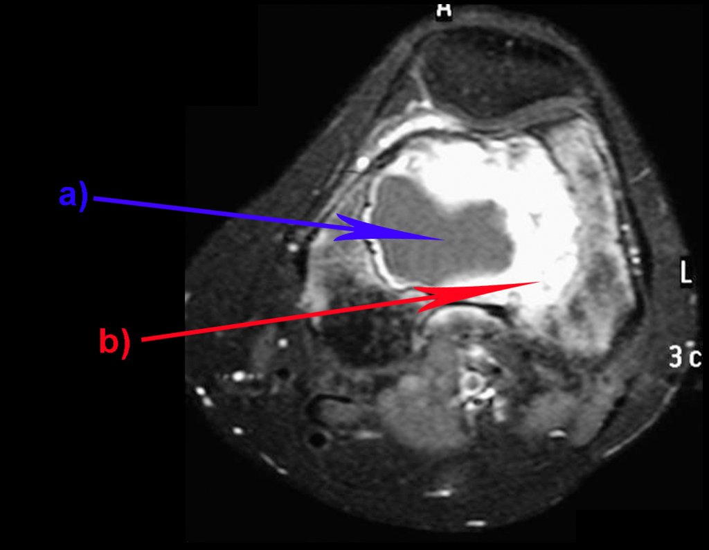 Figura 5: Corte axial de ressonância magnética de tumor de células gigantes do fêmur, com área de cisto ósseo aneurismatico. Idem: conteúdo líquido (a-COA) e áreas sólidas (b-TGC).