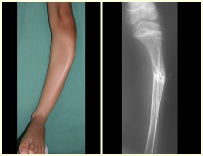 Figura 52 – Deformidade proximal da tíbia em displasia fibrosa. Fig. 53 – Fratura