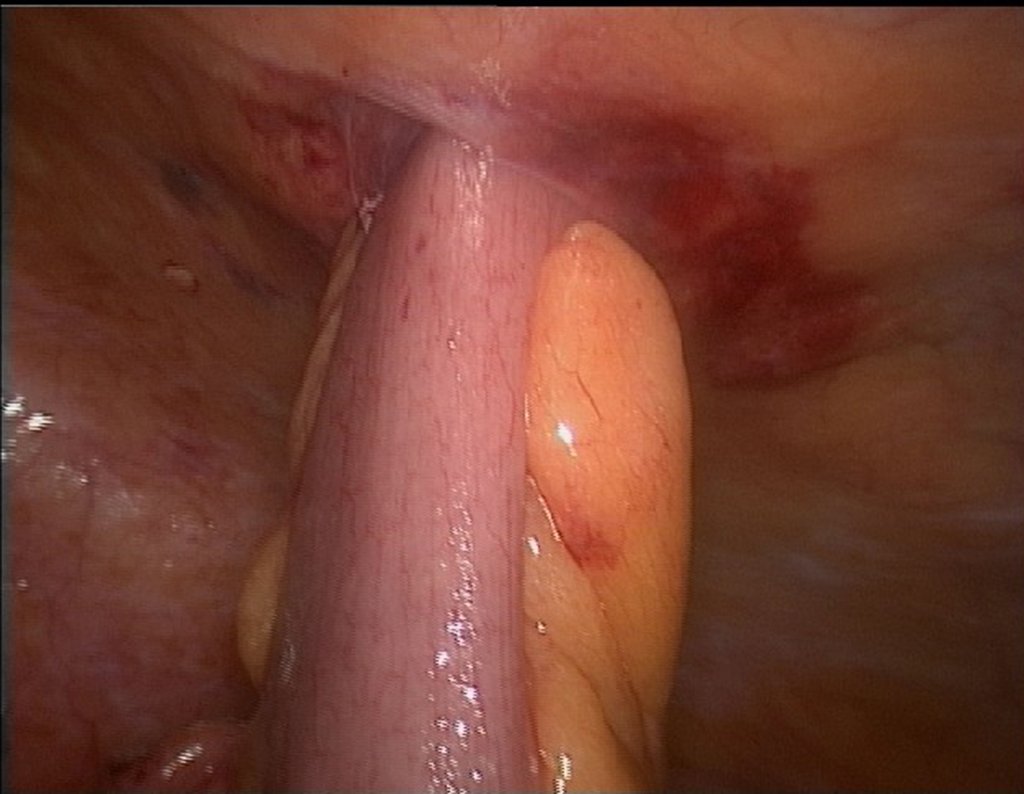 Figura 122: descrição da cirurgia vídeo Laparoscópica.