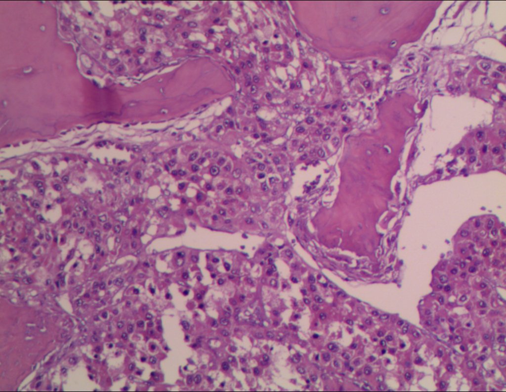 Figura 88: He - Metástase_óssea_de_hepatocarcinoma