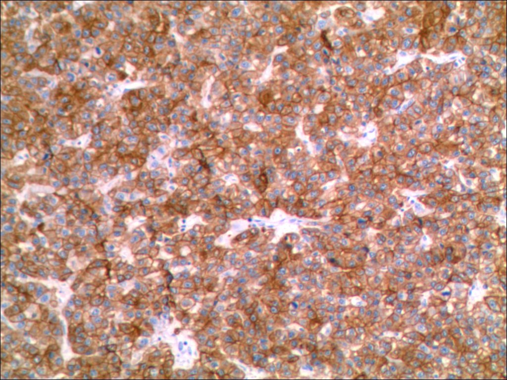 Figura 83: Histologia de metástase óssea de hepatocarcinoma -_AE1AE3_2.