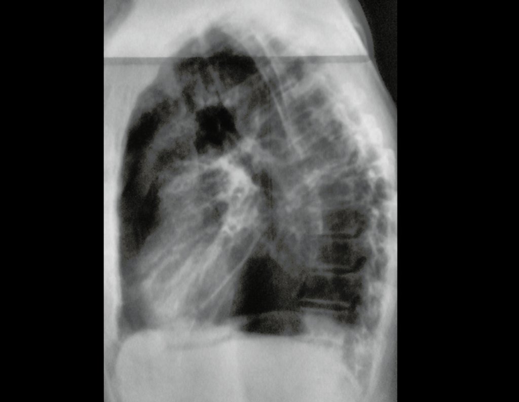 Figura 8: Radiografia de tórax, em perfil absoluto, não aparece a imagem condensante, que sugeria a presença de nódulo no parênquima pulmonar.