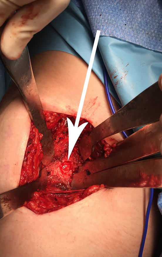 Figura 45: Tumor já removido, observando-se a preservação da cortical interna da diáfise femoral, dispensando a necessidade de enxerto.