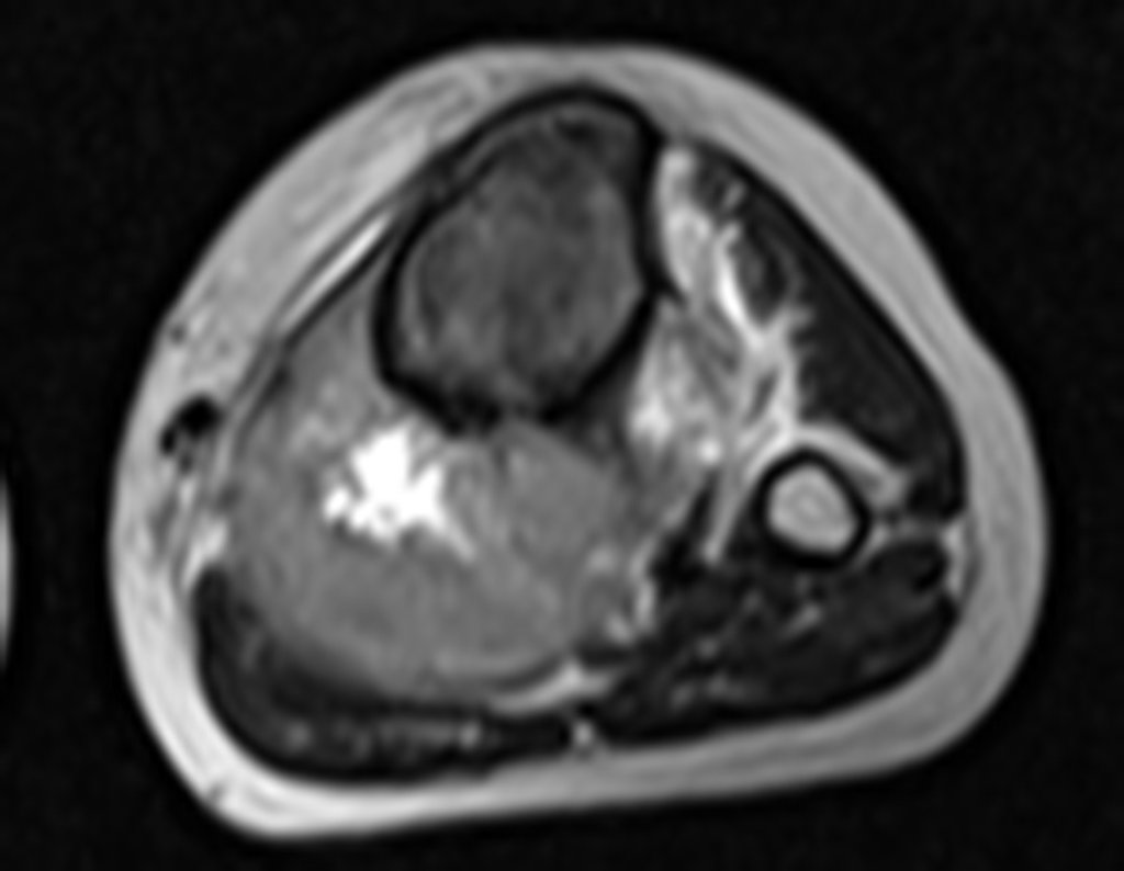 Figura 9: RM axial T2 tse-fil.