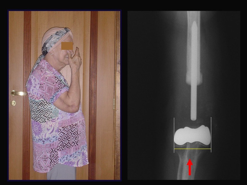 Figura 12: Boa função do cotovêlo. Radiografia evidenciando boa congruência com o cotovêlo da paciente.