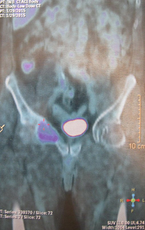 Figura 22: Pet-cet evidenciando o local acometido pelo tumor.