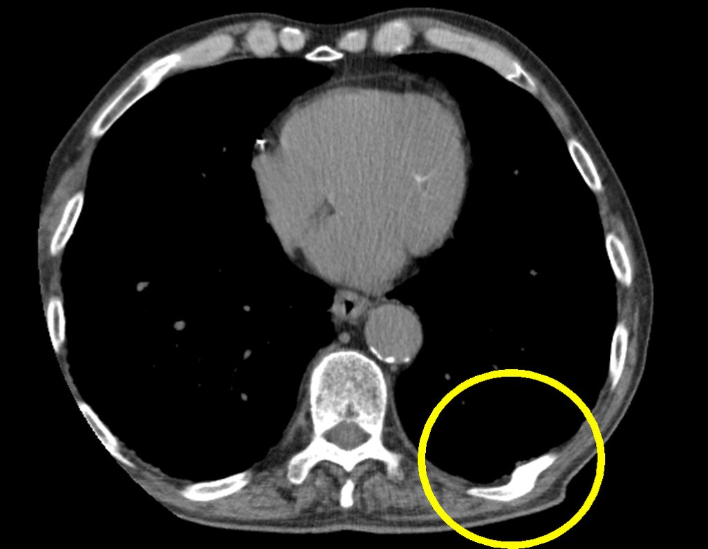 Figura 5: Tomografia axial de tórax, estudo do mediastino inferior, sem evidência de nódulo pulmonar. O círculo em amarelo destaca alteração do nono arco costal posterior do lado esquerdo.