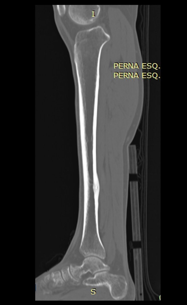 Figura 8: TC sagital evidenciando a lesão na cortical posterior.