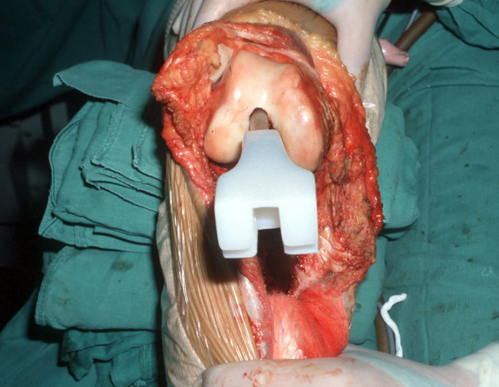 Figura 17: Haste da tíbia posicionada no canal femoral.