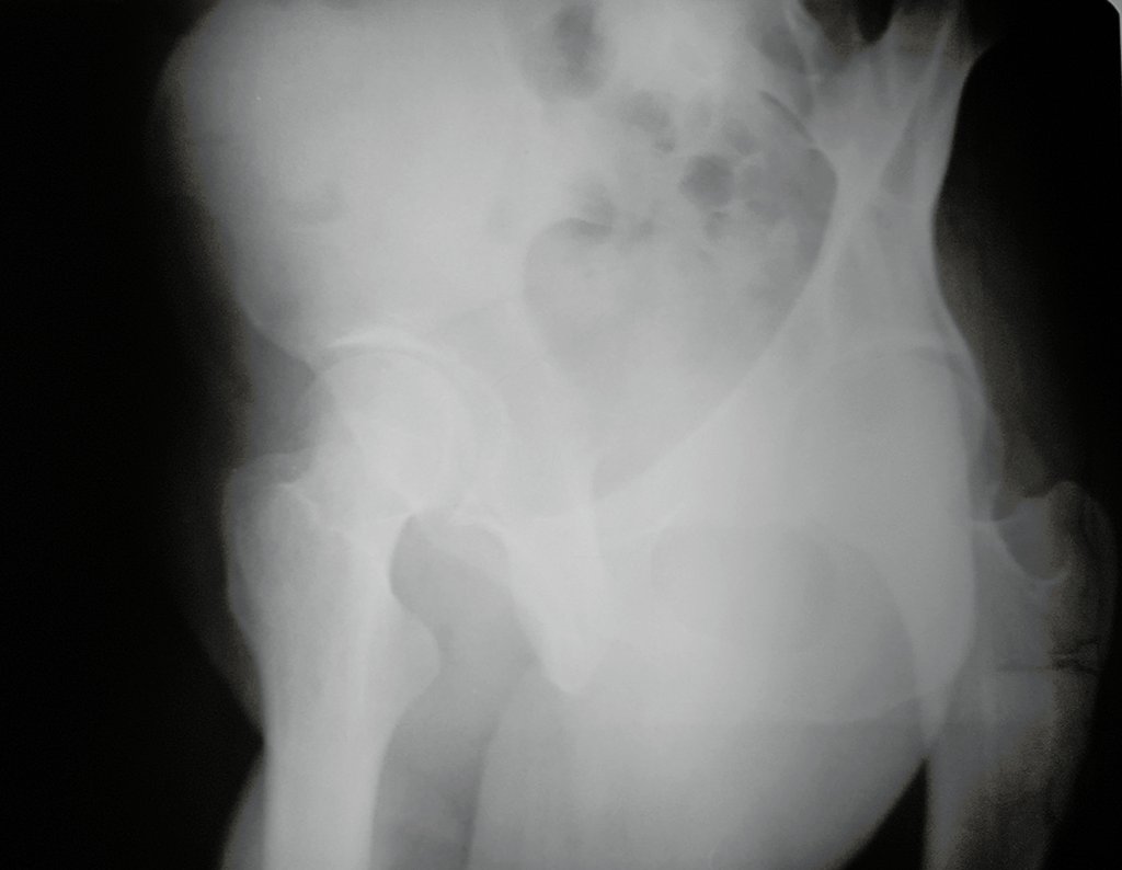 Figura 24: Radiografia da bacia, alar, realizada em 08/12/2016, para controle de infiltração articular.