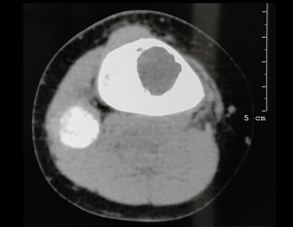 Simple Bone Cyst Of The Tibia Oncosurgery