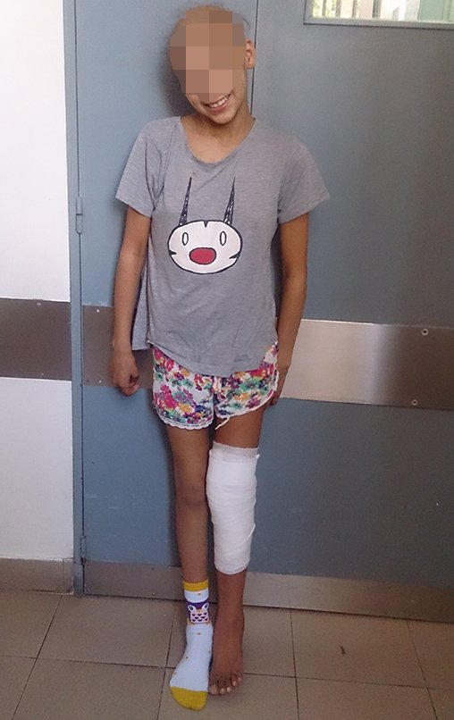 Figura 91: Paciente no dia da alta hospitalar, dez dias após a cirurgia, em 20/08/2015.