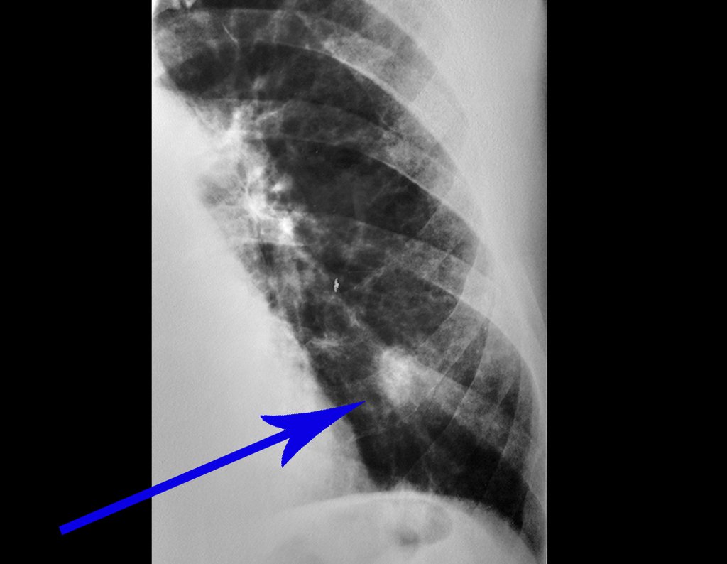 Figura 9: Radiografia de tórax AP, repetida após a tomografia, focalizada, esclarecendo que a condensação corresponde ao calo de fratura do 90 arco costal posterior.