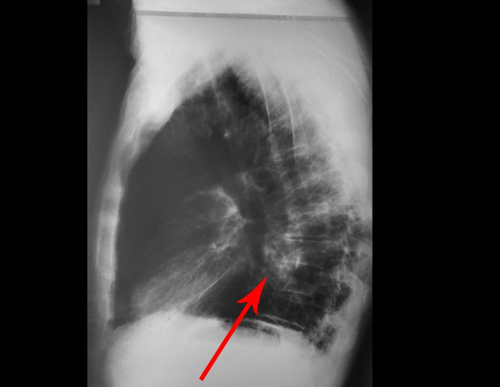 Figura 2: Radiografia de tórax em oblíqua (os corpos vertebrais encontran-se sobrepostos aos arcos costais), com seta em vermelho, sinalizando aumento de densidade na projeção do lobo inferior do pulmão esquerdo.