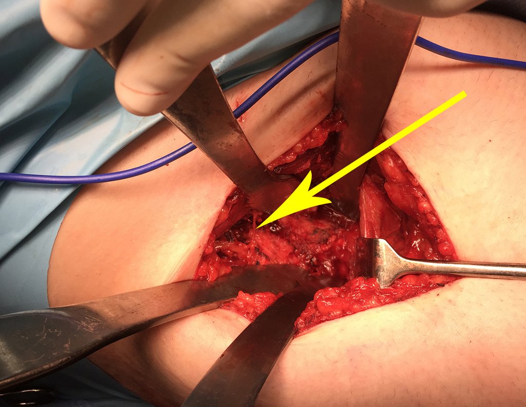 Figura 42: Ramo nervoso liberado e protegido por afastador de Homma, apoiado na cortical lateral da diáfise femoral. A seta assinal o nervo isolado.