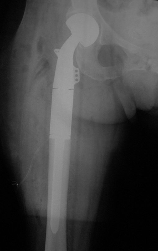 Figura 79: Radiografia do quadril direito frente, mostrando a boa posição da prótese.