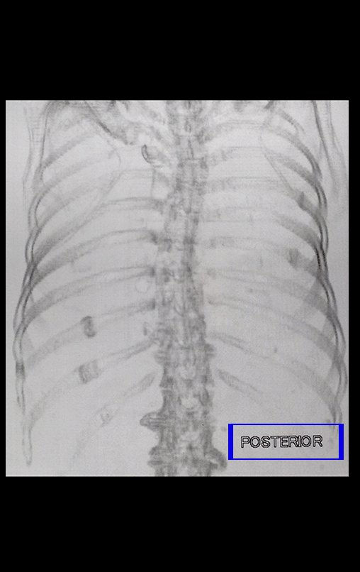 Figura 11: Tomografia de tórax. tomada póstero-anterior, destacando calo de fraura no 90 e 100 arcos costais posteriores à esquerda e no 50 e 70 arcos costais porteriores à direita.