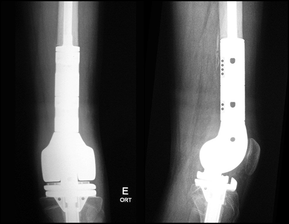 Figura 5: Radiografia de 30/03/2016, post op 3 meses, frente. Figura 6: Radiografia de 30/03/2016, post op 3 meses, perfil.