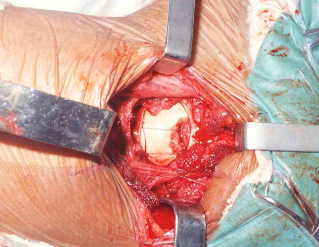 Figura 5: Acesso medial ao colo femoral, como membro el flexão e rotação externa, expondo a região póstero-medial da cabeça femoral, Abertura da cápsula articular em H. Realizamos quatro. Incisões na cartilagem. Uma perpendicular ao colo e três horizontais.