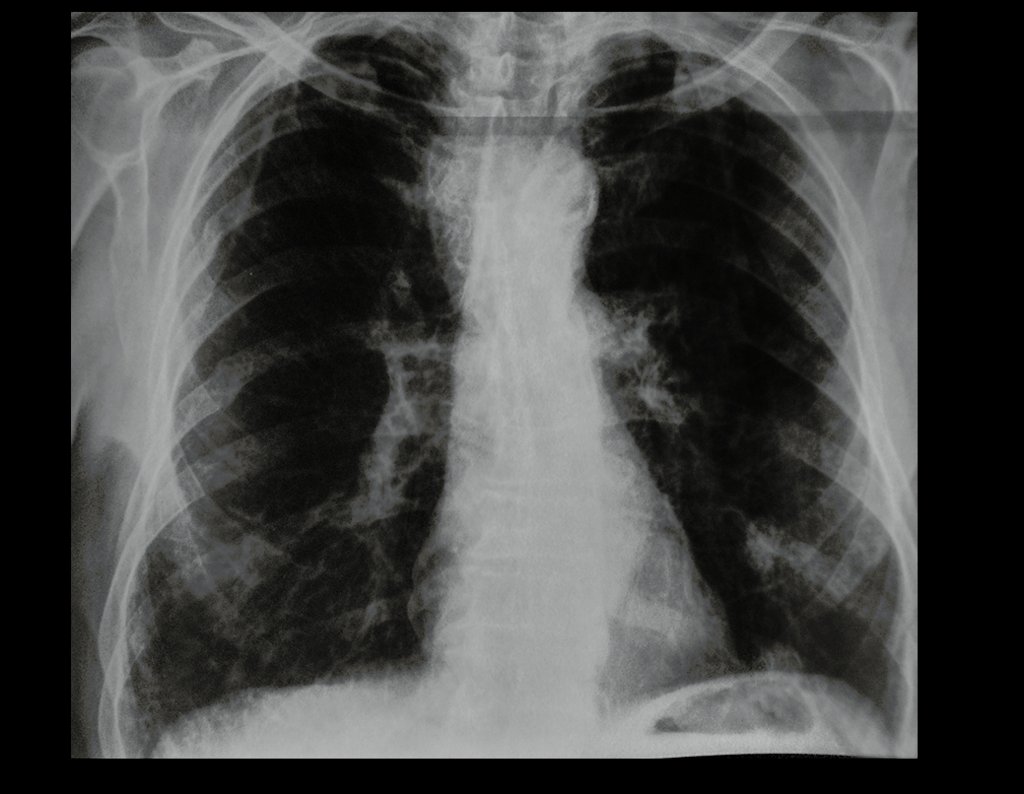 Figura 7: Radiografia de tórax AP, repetida após a tomografia, corroborando a presença da imagem condensante, na projeção do lobo inferior do pulmão esquerdo.