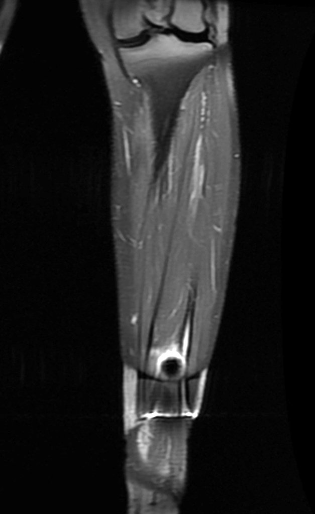 Figura 15 : Rm coronal com captação linear do contraste.