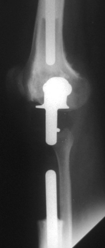 Figura 28: Radiografia, perfil, após três meses da cirurgia.