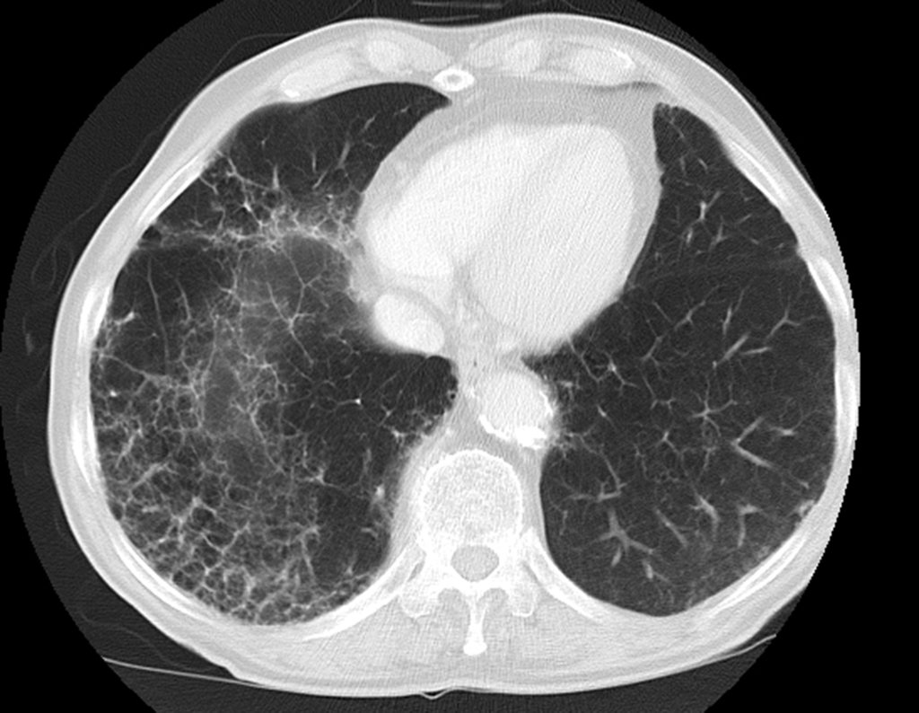 Figura 4: Tomografia axial de tórax, corte inferior, evidenciando um pulmão de fumante crônico, com enfisema pulmonar.