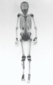 Figura 11 A: Cintilografia óssea, fase tardia, mostrando captação no 1/3 distal da perna, confirmando a presença de vascularização da fíbula transplantada.