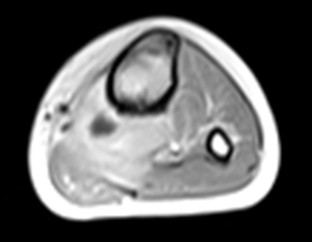 Figura 28: RM axial T1 tse-fil-gad.