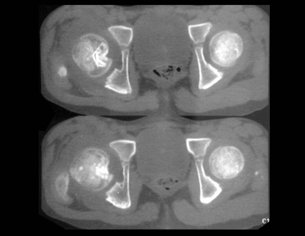 Figura 14: Tomografia de 13/07/1994, após dois anos e seis meses da cirurgia.