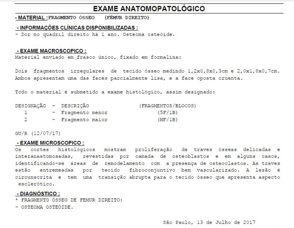 Figura 51: Laudo anátomo patológico confirmando o diagnóstico de osteoma osteóide.