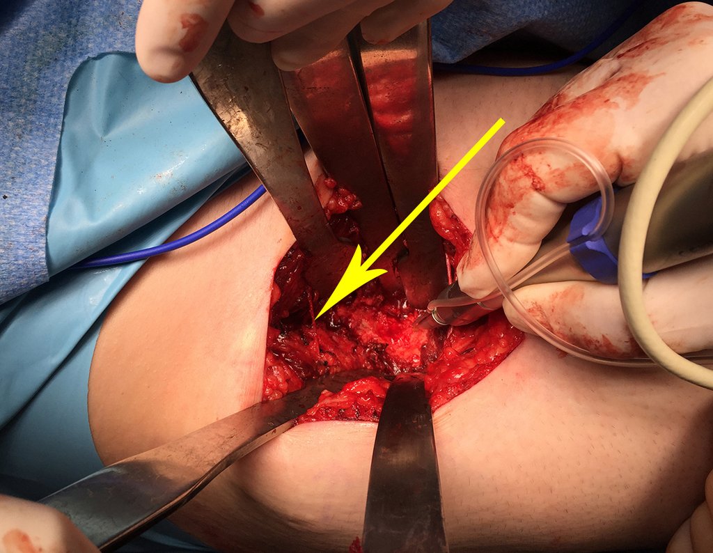 Figura 44: Delimitação da periferia do tumor com aparelho surgic pró, utilizando brocas minimamente invasivas, irrigadas por soro fisiológico.