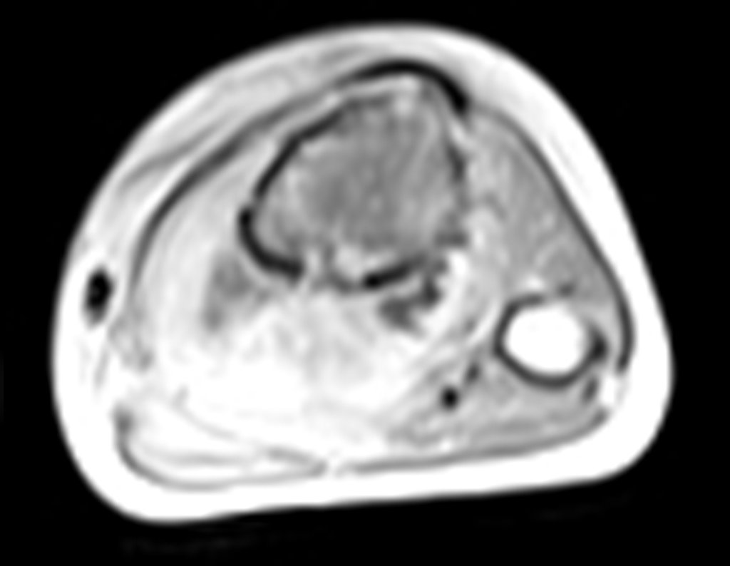 Figura 26: RM axial T1 tse-fil gad.