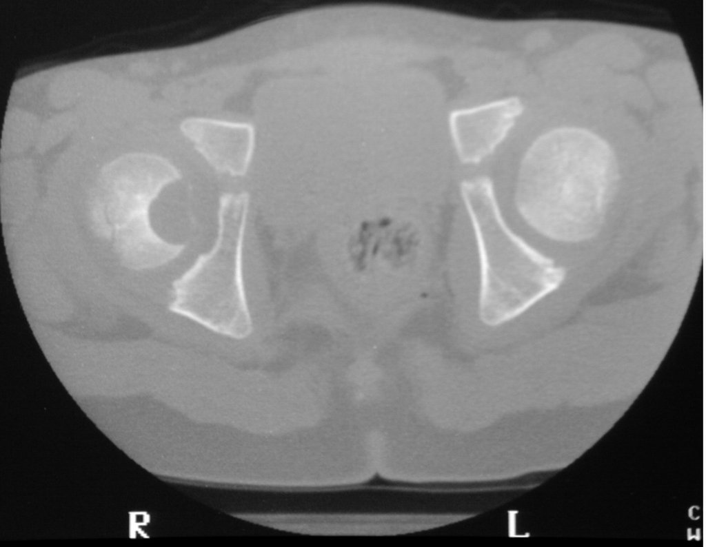 Figura 3: Tomografia do quadril com lesão na cabeça femoral direita, densidade para tecido ósseo.