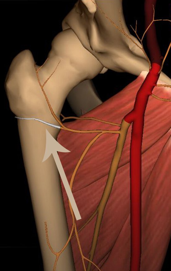 Figura 35: Ramo transverso da artéria circunflexa anterior, em branco, passando por cima da lesão.