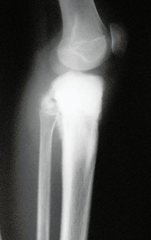 Figura 42: Radiografia de perfil da tíbia esquerda, evidenciando a lesão na região proximal.