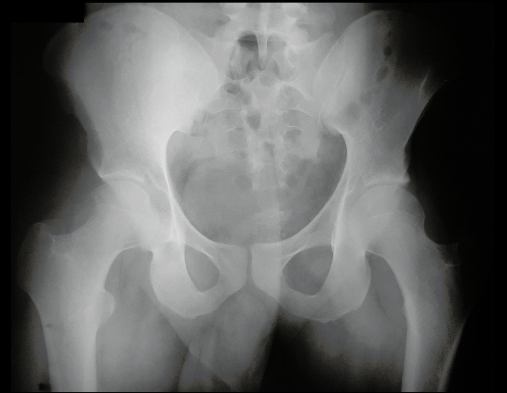 Figura 22: Radiografia da bacia, frente, realizada em 08/12/2016, para controle de infiltração articular.